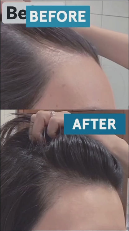 Derma Roller Facial & Hair Therapy 540 Titanium Microneedle Hair Regrowth Beard Growth Anti Hair Loss Treatment Thinning